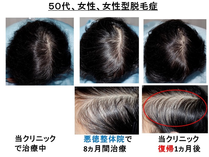 円形脱毛症　病院